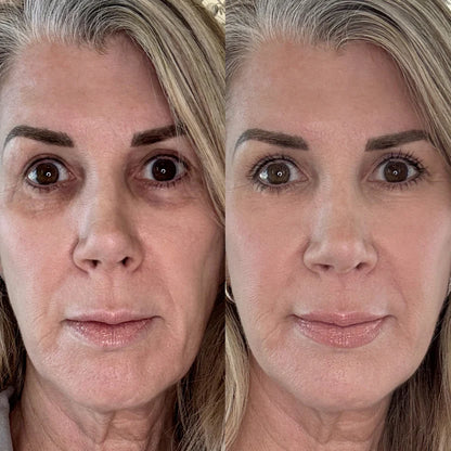 KalmEyes™ 2-in-1 Red Light Therapy + EMS To Erase Eye Bags