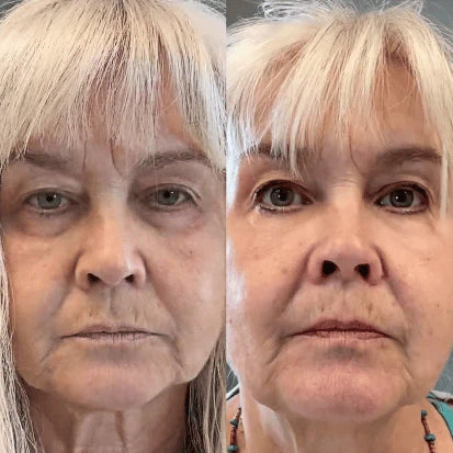 KalmEyes™ 2-in-1 Red Light Therapy + EMS To Erase Eye Bags