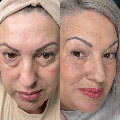KalmEyes™ 2-in-1 Red Light Therapy + EMS To Erase Eye Bags